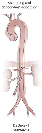 File:Aortic dissection of DeBakey type I.png