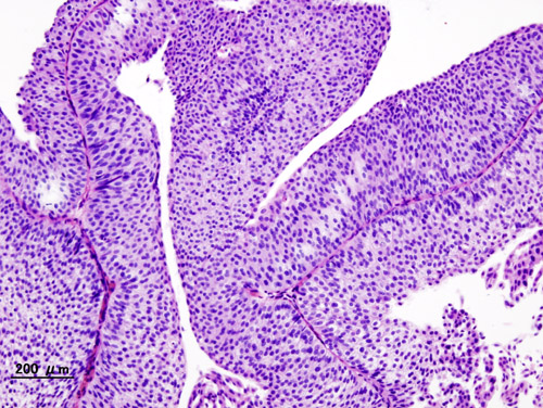 File:Bladder urothelial carcinoma (1) pT1.JPG