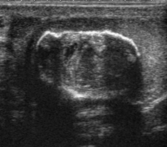 File:Ultrasonography of teratoma.jpg
