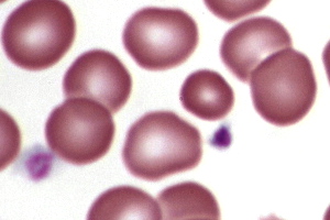 Microcytes-1.JPG