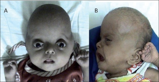 Pfeiffer's syndrome type II with cloverleaf shaped skull and bilateral proptosis.png