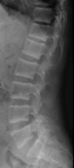 X-ray of rugger-jersey spine of renal osteodystrophy.jpg