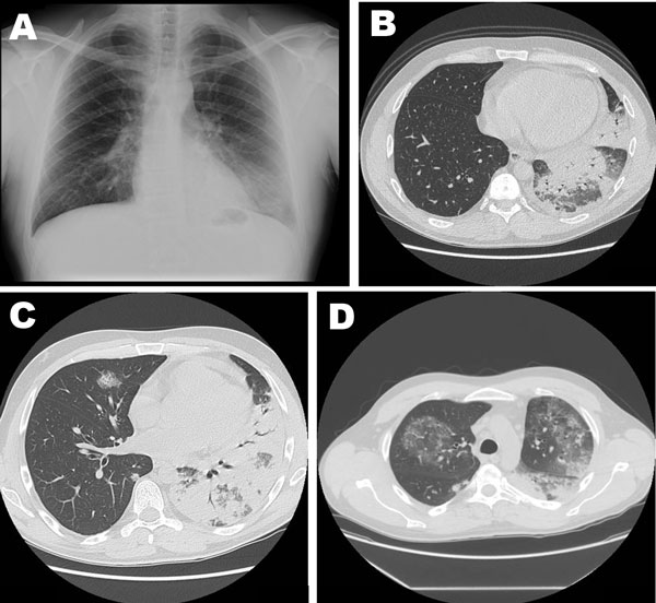 File:Severe Pneumonia Caused by Legionella pneumophila Serogroup 11, Italy.jpg