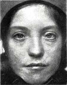 Patient with Waardenburg-Klein syndrome (1916).jpg