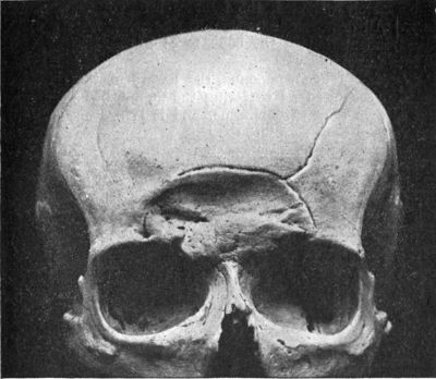 File:Depressed skull fracture2.jpg