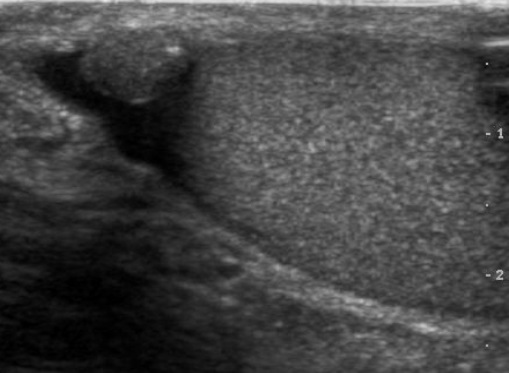 File:Scrotal ultrasonography of fibrous pseudotumour.jpg