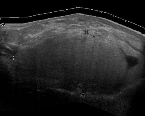 File:Scrotal ultrasonography of liposarcoma mimicking a lipoma.jpg