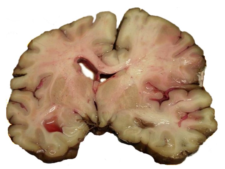 File:MCA-Stroke-Brain-Human-2.JPG