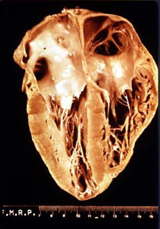 File:Heart pathology Chagas disease.JPG