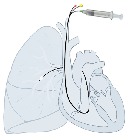 File:Pulmonary artery Catheter.png