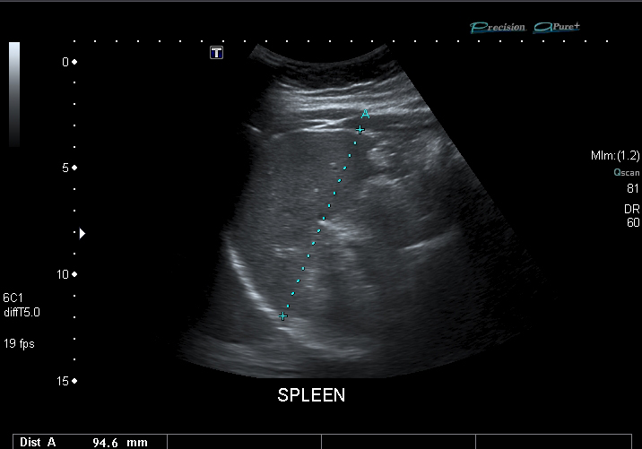 File:Spleen ultrasound.jpg