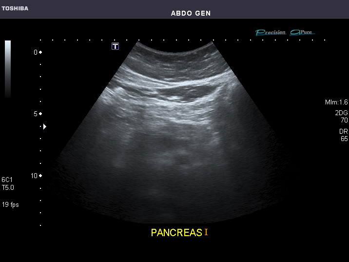 File:Abdominal Ultrasound Full Exam 38.jpg