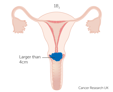 File:Diagram-showing-stage-1B3-cervical-cancer.png