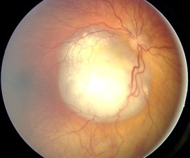 File:Fundus retinoblastoma.jpg