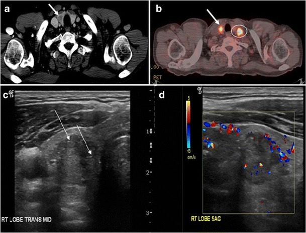 File:Papillary thyroid carcinoma on CT, PET CT and ultrasonography.jpg ...