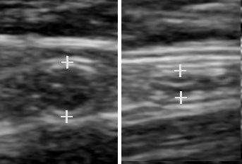 File:Ultrasonography of a normal appendix without and with compression.jpg