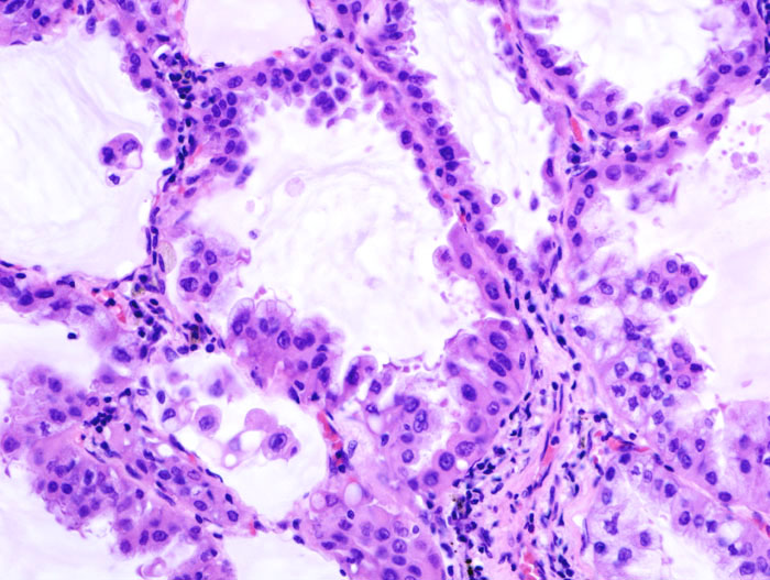 File:Brochiolo-alveolar carcinoma with mucin production (1).jpg
