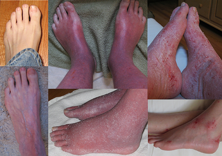 File:Red (burning) Skin Syndrome - Feet Collage.jpg