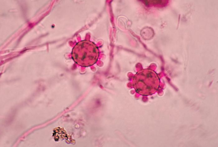 File:Tuberculate macroconida of the Jamaican isolate of Histoplasma capsulatum PHIL 4023 lores.jpg