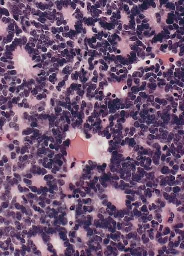 File:Retinoblastoma rosette.jpg