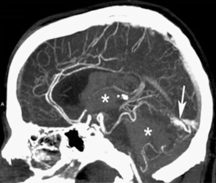 File:CT angiography of a vascular malformation with intraventricular hemorrhage.png