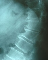 Thoracic Spondylosis.JPG