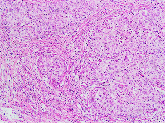 File:Histopathology of squamous cell carcinoma of the cervix.png
