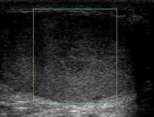 File:Scrotal ultrasonography of testicular torsion.jpg