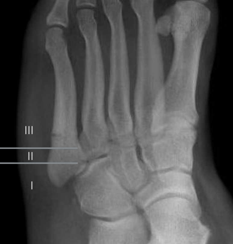 File:Jones fracture, healing zones according to Polzer.jpg - HandWiki