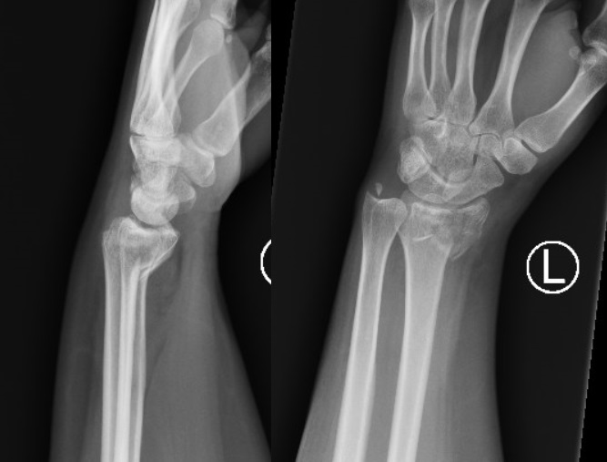 Medicine:Smith's fracture - HandWiki