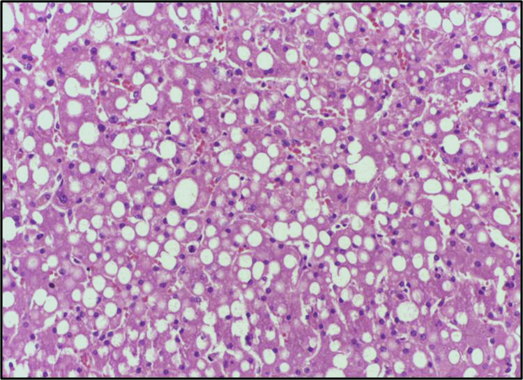 File:Fatty change liver - Lipid steatosis 10X.jpg