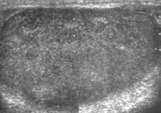 File:Scrotal ultrasonography of leukemia.jpg