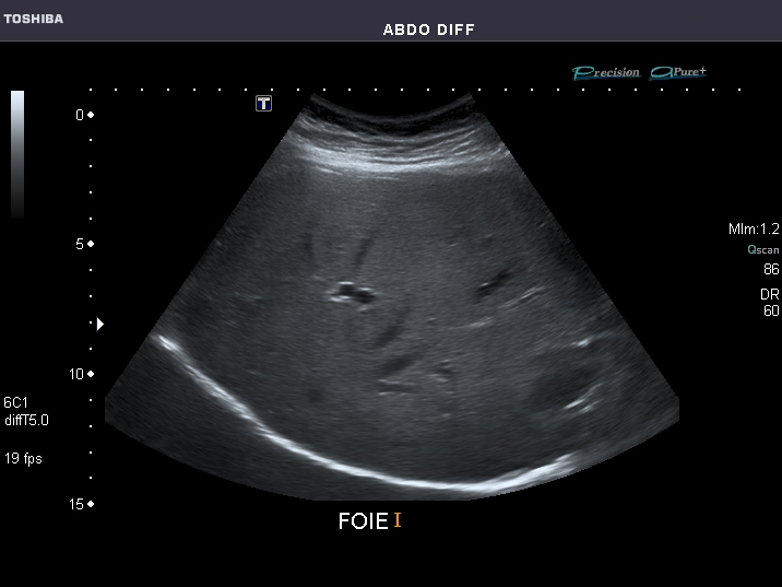 File:Abdominal Ultrasound Full Exam 14.jpg