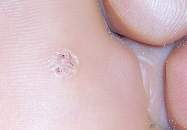 File:Veruca right foot detail.jpg