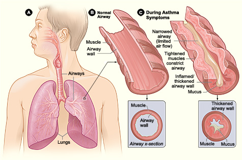 File:Asthma attack-illustration NIH.jpg
