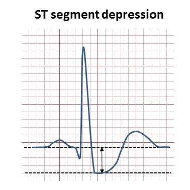 File:ST depression illustration.jpg