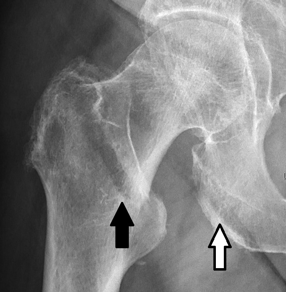 File:Skin folds close to a hip fracture (with arrows).jpg
