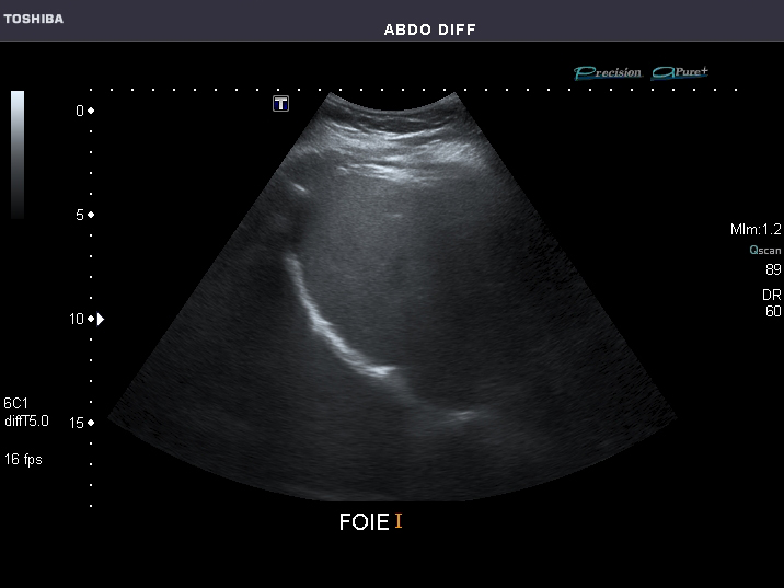 File:Abdominal Ultrasound Full Exam 19.jpg