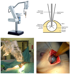 The technique of targeted intraoperative radiotherapy for breast cancer.png