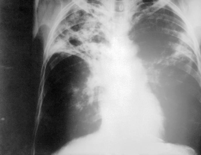 File:Tuberculosis-x-ray.jpg