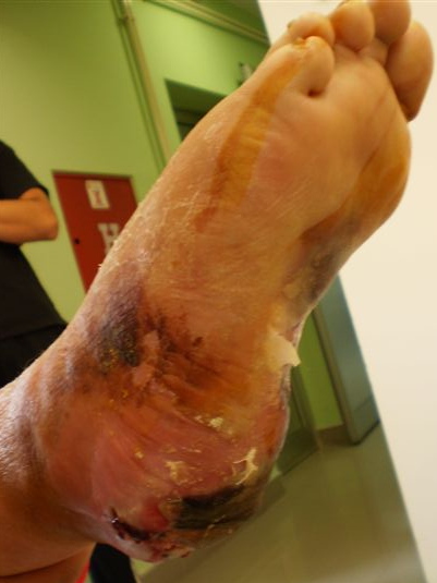 File:Diabetic foot ulceration.jpg