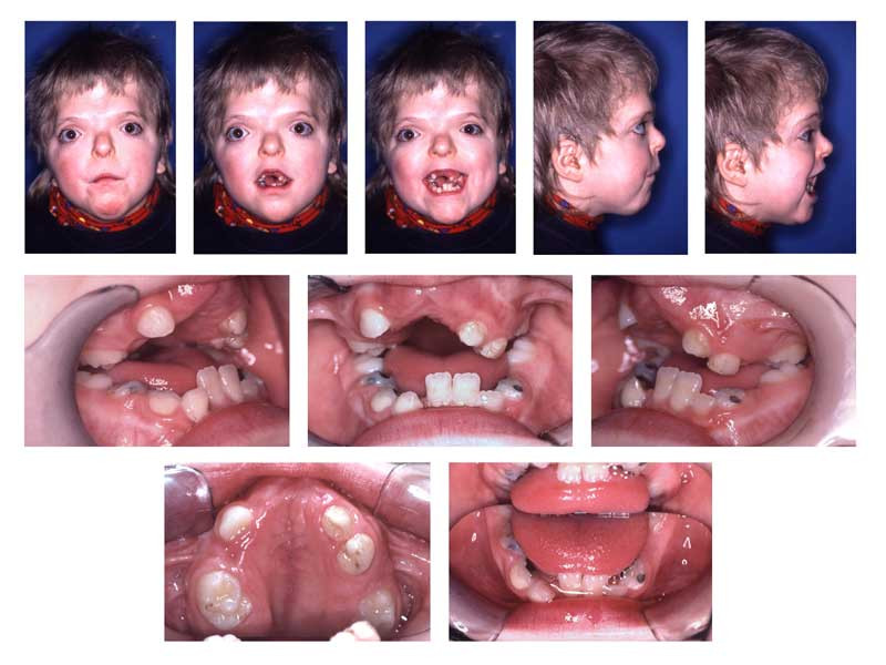File:Patient with Apert syndrome.jpg