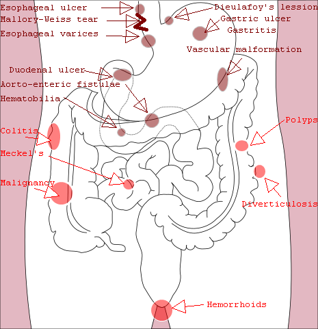 File:Causes of gastrointestinal bleeding.png