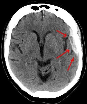 File:Ct-scan of the brain with an subdural hematoma.jpg