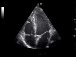 File:Ultrasound of human heart apical 4-cahmber view.gif
