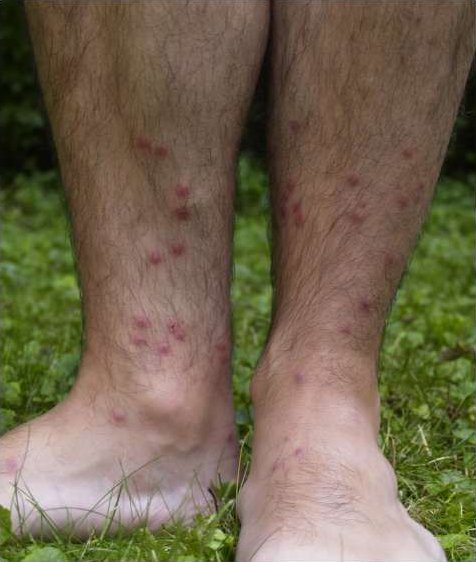 File:Cercarial dermatitis lower legs.jpg