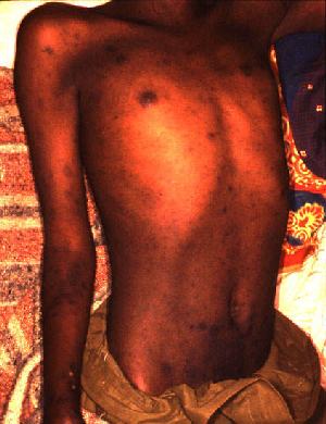 File:Epidemic typhus Burundi.jpg