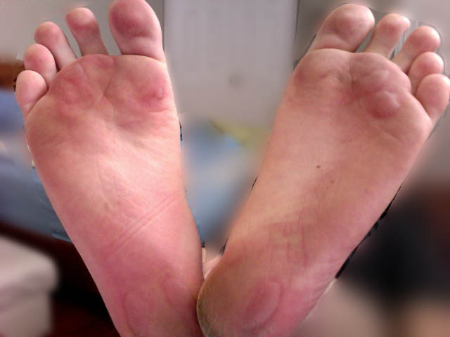 File:Friction Blisters On Human Foot.jpg