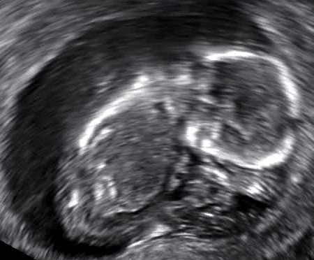 File:Delayed or missed miscarriage at 13 weeks.gif
