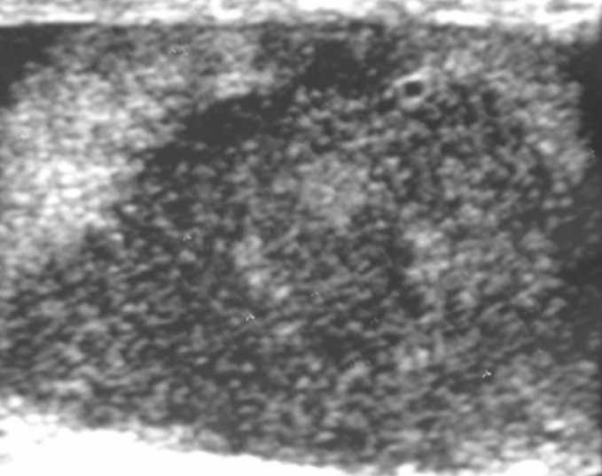 File:Scrotal ultrasonography of lymphoma.jpg